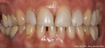 Denti frontali superiori da trattare