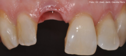 Mancanza del dente e impianto inserito