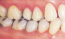 Parodontite: infezione cronica delle gengive
