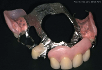 Parti metalliche, di resina rosa (gengive) e bianche (denti)