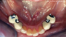 denti inferiori naturali e ricoperti con corone in ceramica con attacchi a binario