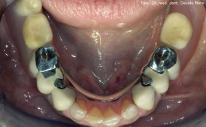 Protesi scheletrata inferiore inserita in bocca grazie ai binari presenti sulle corone in oro-ceramica