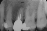 RX infezione della radice di dente non recuperabile